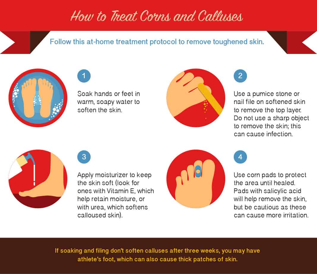How to Treat Corns and Calluses